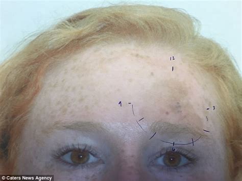Mother Who Mistook Her Skin Cancer For Hormonal Changes