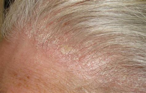 Red Patches On Scalp And Thinning Hair Red Hair