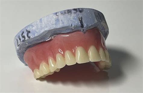 Traditional Vs Implant Supported Dentures The Dental Lab