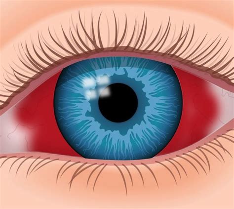 Subconjunctival Hemorrhage Blood In The Eyes Dr Reichmann