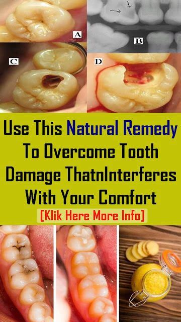 Try This Natural Remedy It Will Help You To Treat Tooth Decay And You