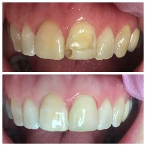 Bannon is well versed in a variety of cosmetic dental areas such as being an invisalign dentist, experienced with dental implants and. N Downers Grove IL, Tower Dental Associates