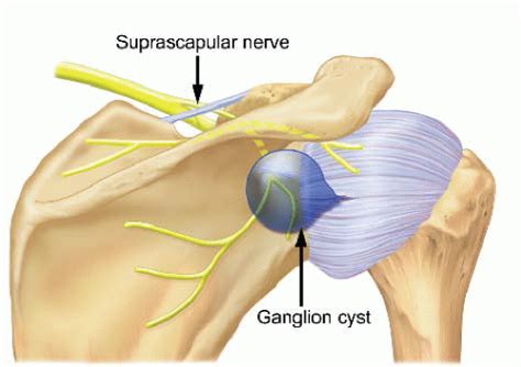 Periarticular Ganglion Cysts Of The Shoulder Musculoskeletal Key