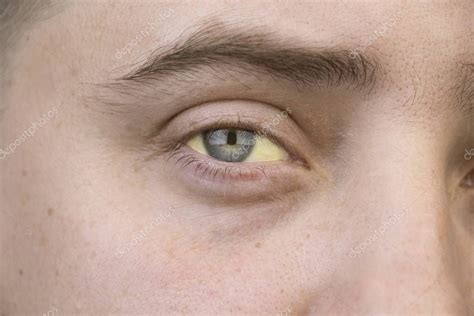 el color amarillo del ojo masculino síntoma de ictericia hepatitis o problemas en la vesícula