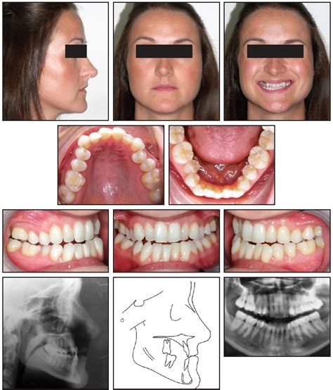 Invisalign Treatment Of Class Iii Malocclusion With Lower Incisor