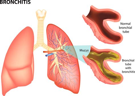 Bronchitis - Ambient Virtual Care