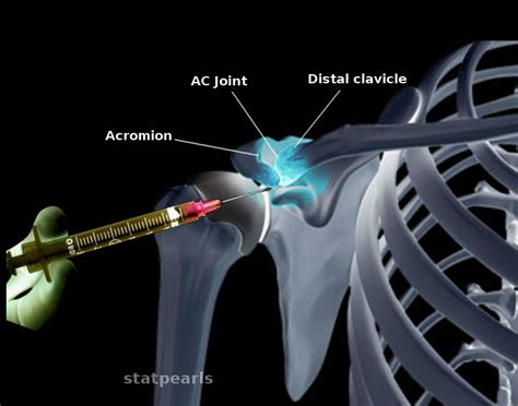 Figure Ac Joint Injection Image Courtesy Ochaigasame Statpearls
