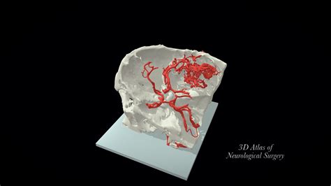 Vascular Brain Tumor 3d Model By 3d Atlas Of Neurological Surgery