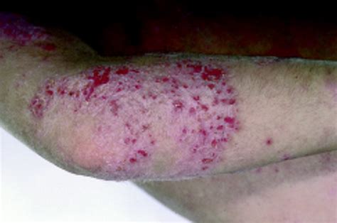 Allergy And The Skin Ii—contact And Atopic Eczema The Bmj