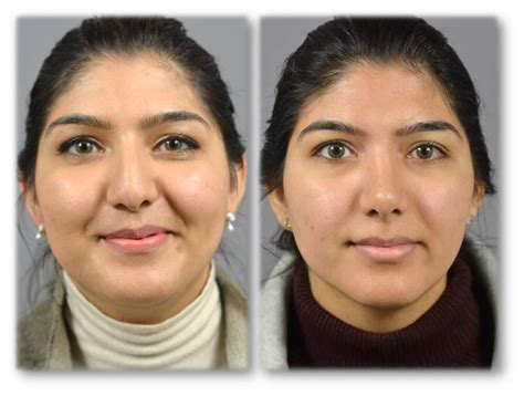 Nose Surgery Before And After Long Island Dr Marotta