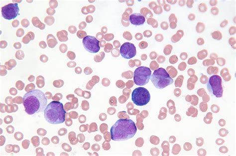 Microscopic Views Of Leukemia And Lymphoma Blood Cancer