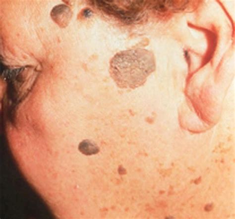 Top 95 Pictures Pictures Of Large Seborrheic Keratosis Excellent
