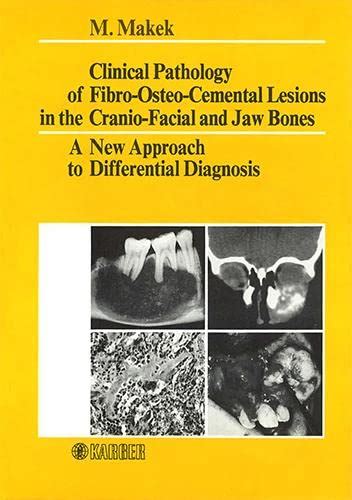 Clinical Pathology Of Fibro Osteo Cemental Lesions In The Cranio Facial