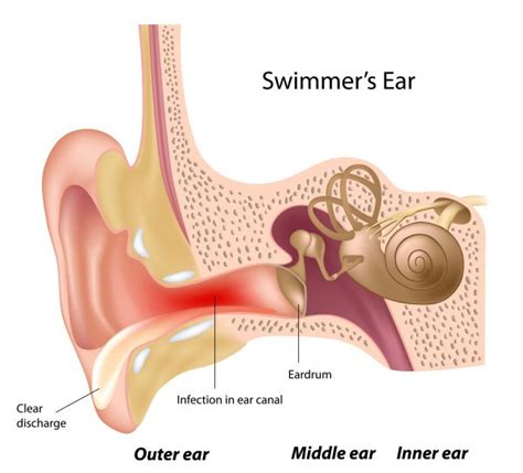 Understanding And Treating Swimmers Ear Lexington Medical Center