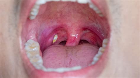 A Pimple In The Throat Can Be A Symptom Of Other Illnesses