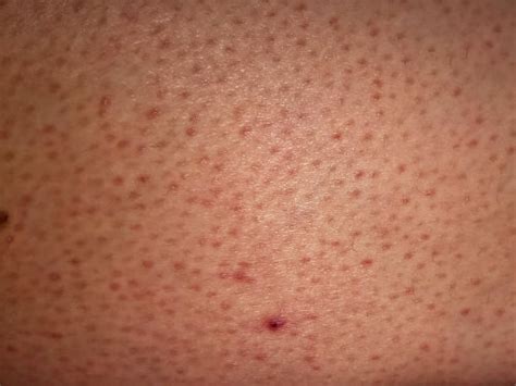 Bumps On Face Acne Or Keratosis Pilaris March 2020 And Tiege Hanley