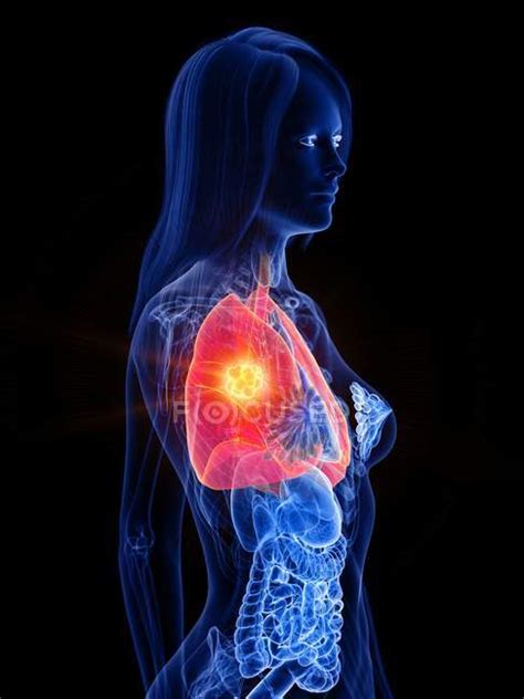 Lung Cancer In Female Transparent Body Conceptual Computer