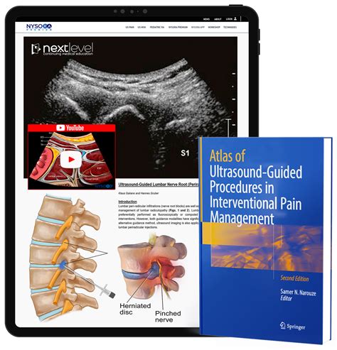 Ultrasoundguided Procedures In Interventional Pain Management Nysora