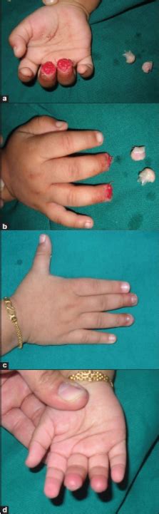 Nail Bed Injuries And Deformities Of Nail Scienceopen