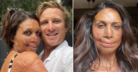 Turia Pitt S Confronting Photo Discovery On USB Really Upset