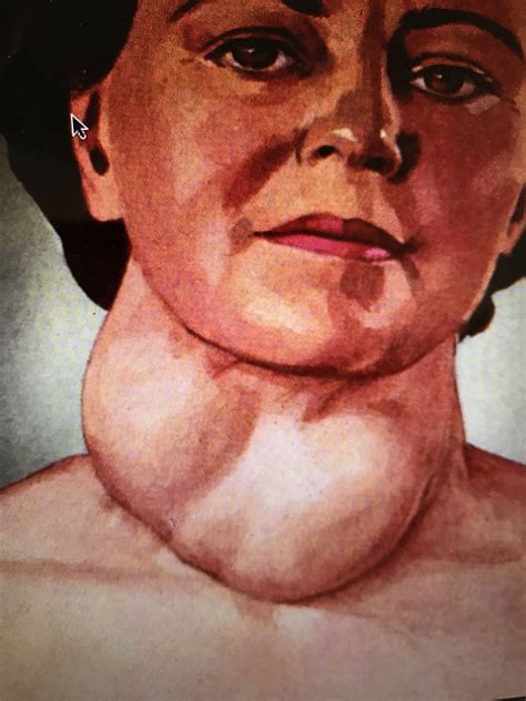 Simple Goiter Not So Simple After All Alternative To Eventual Surgery