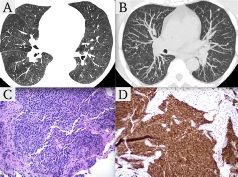 Diffuse Idiopathic Pulmonary Neuroendocrine Cell Hyperplasia An Asthma