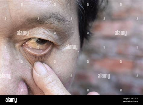 Pale Skin Of Asian Elderly Man Sign Of Anemia Pallor At Eyelid Stock
