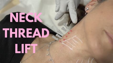 Neck Thread Lift Procedure By Dr Nina Bal 💕 Pdo Neck Thread Lift Before