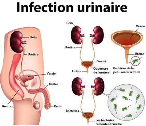 Infection urinaire homme causes symptômes traitements Information hospitalière Lexique