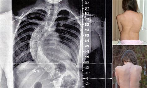 Scoliosis Schoolgirl With The Worst Spinal Curvature Doctors Had