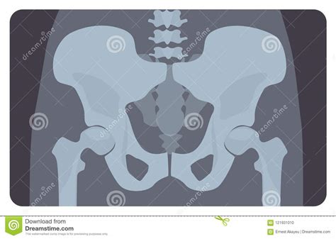 Anterior Radiograph Of Human Pelvis Or Hip Bone With Lumbar Part X Ray