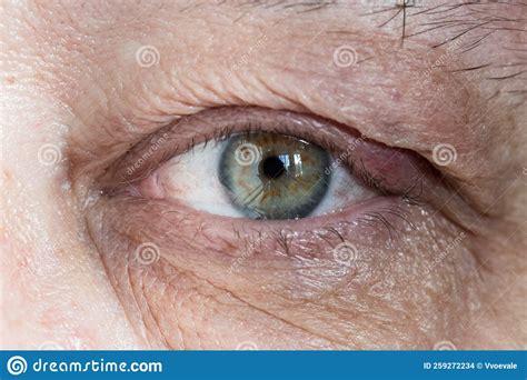 Inflamed Male Eye With Chalazion On Eyelid Stock Photo Image Of Male