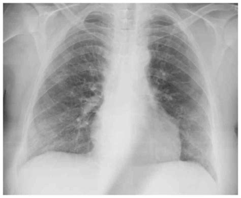 Interstitial Pneumonia X Ray