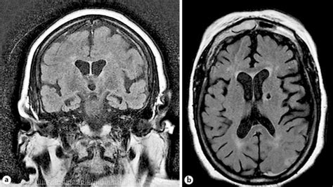 Admission Mri Supporting The Diagnosis Of Mixed Dementia Of Alzheimers