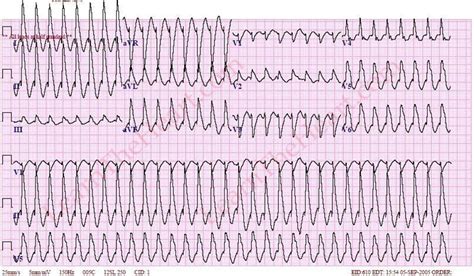 Monomorphic Ventricular Tachycardia Ecg