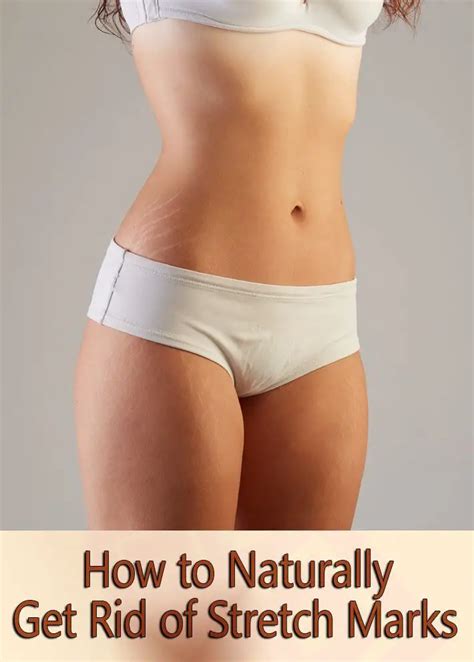 Stretch Marks What You Should Know And How To Get Rid Of Them
