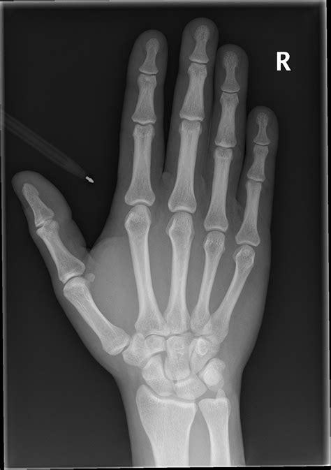 Normal Hand Series Radiology Case