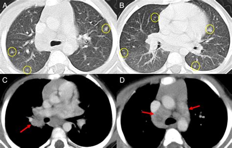 Radiographic Features Of Patients With Chronic Granulomatous Disease