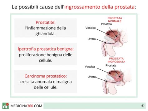 Prostata Ingrossata Sintomi Cause Cura Rischi Dieta E Rimedi Naturali