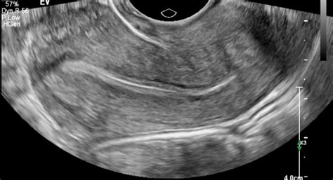 Figure Transvaginal Longitudinal View Of The Uterus Contributed By Dr