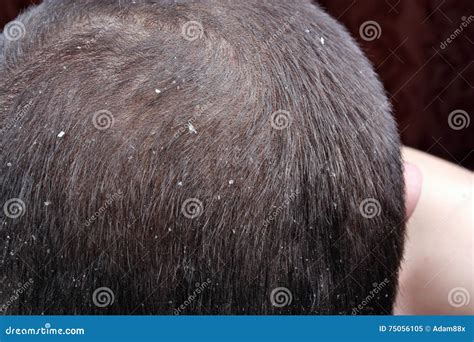 White Flakes In Hair Not Dandruff Spefashion