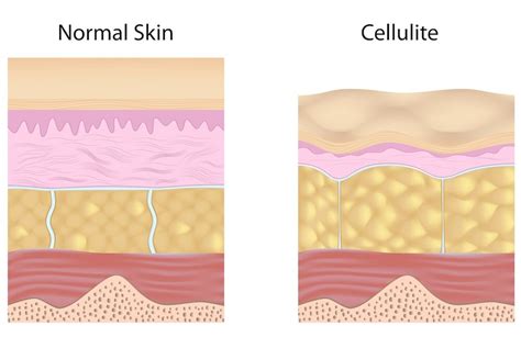 What Is Cellulite Exactly What Causes It And How Is It Formed
