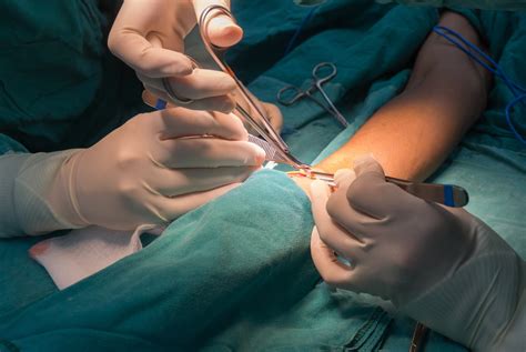 Arteriovenous Fistulas Often Require Intervention Renal And Urology News