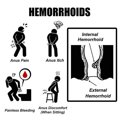 Oem Medical Hemorrhoid Ointment Relieve Hemorrhoid Pain Anal Bleeding Swelling Anal Fissure