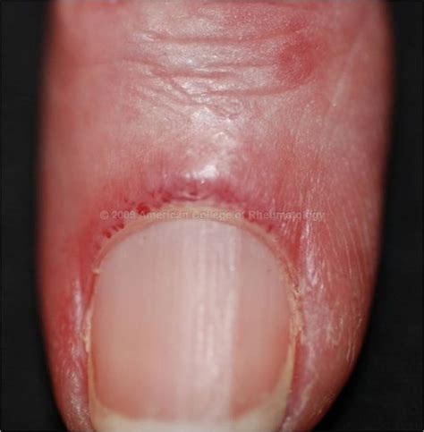 Amyopathic Dermatomyositis Nailfold Capillary Telangiectasia Finger