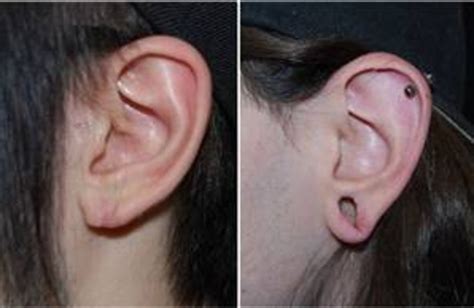 Ears After Gauges