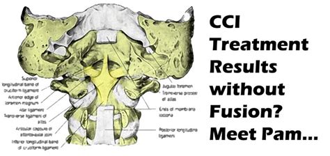 Cranial Cervical Instability