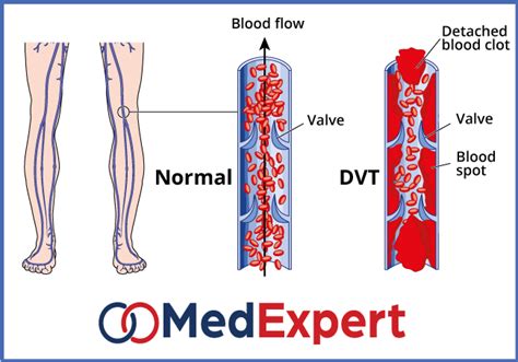 Deep Vein Thrombosis Treatment Diagnosis And Dvt Symptoms Med Expert