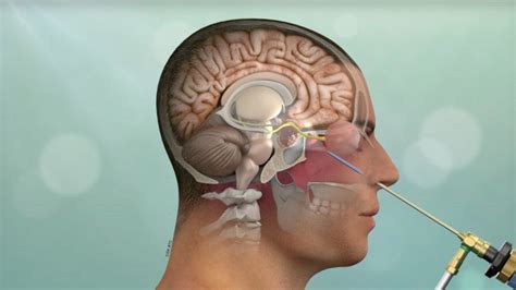Minimally Invasive Brain Surgery Keyhole Craniotomy Pacific Brain