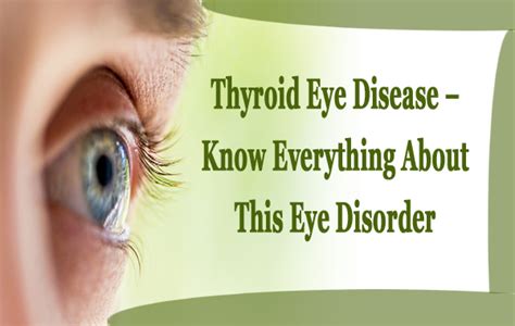 Thyroid Eye Disease Know Everything About This Eye Disorder